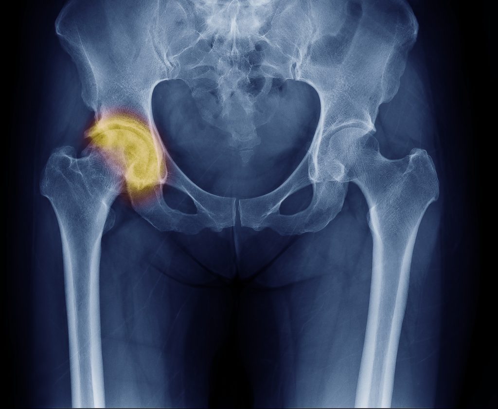 Złamania osteoporotyczne – dlaczego są groźne i kto jest na nie najbardziej narażony
