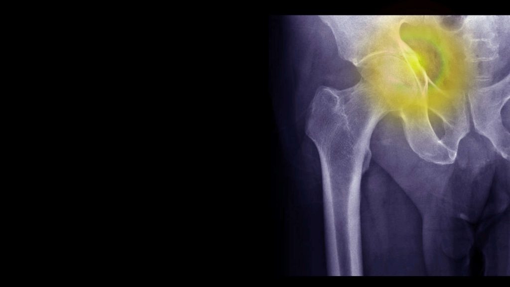 Jakie są rodzaje złamań? Jak ich unikać w osteoporozie?