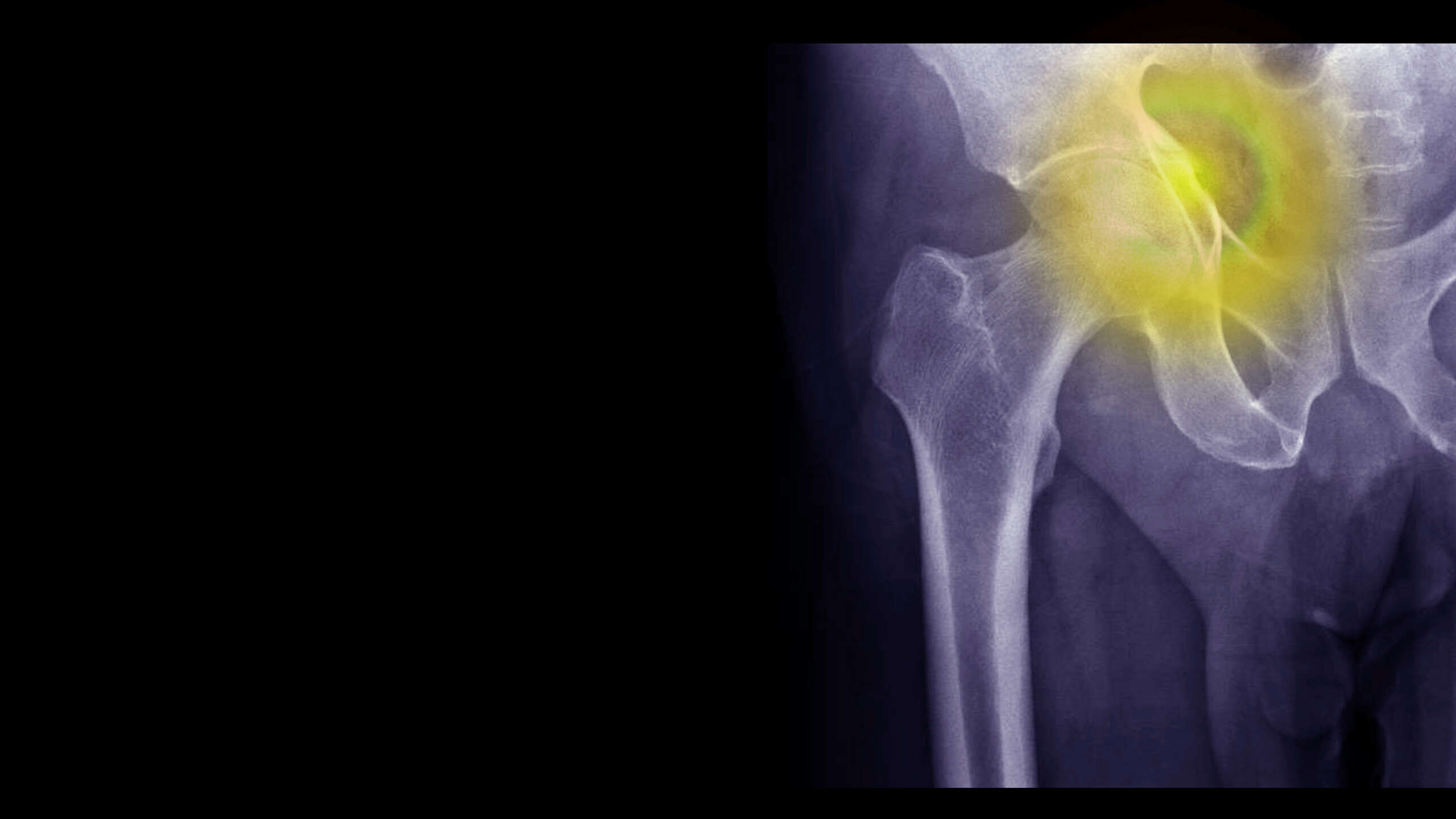 Jakie są rodzaje złamań? Jak ich unikać w osteoporozie?